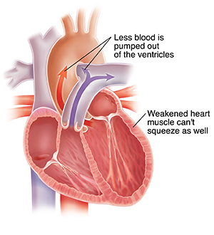 Cross section of heart showing weakened heart muscle causing less blood to be pumped out of ventricles.